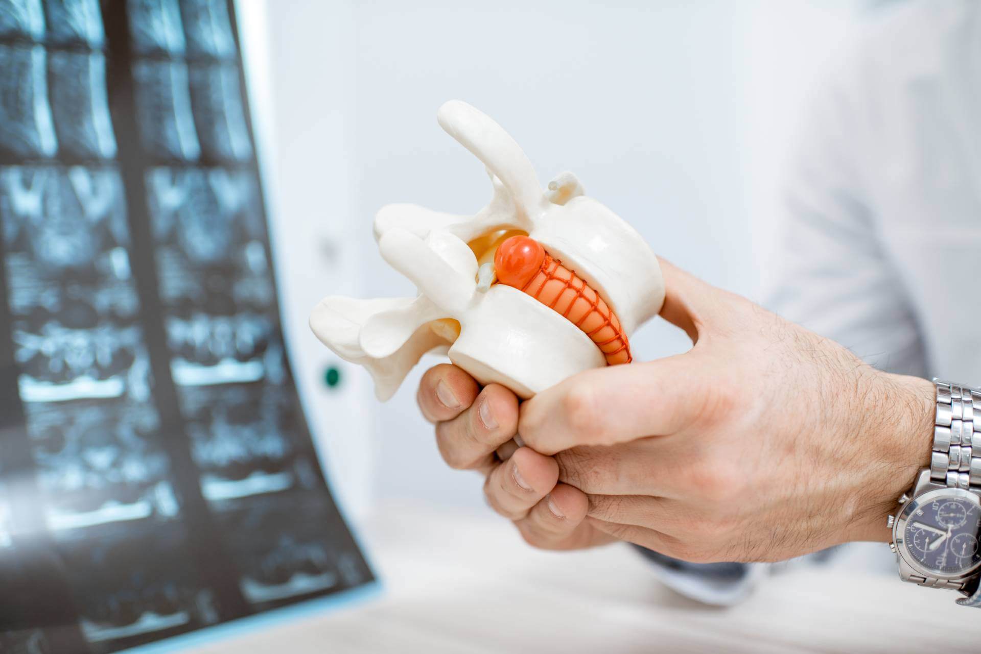 3D model of vertebra with herniated disc